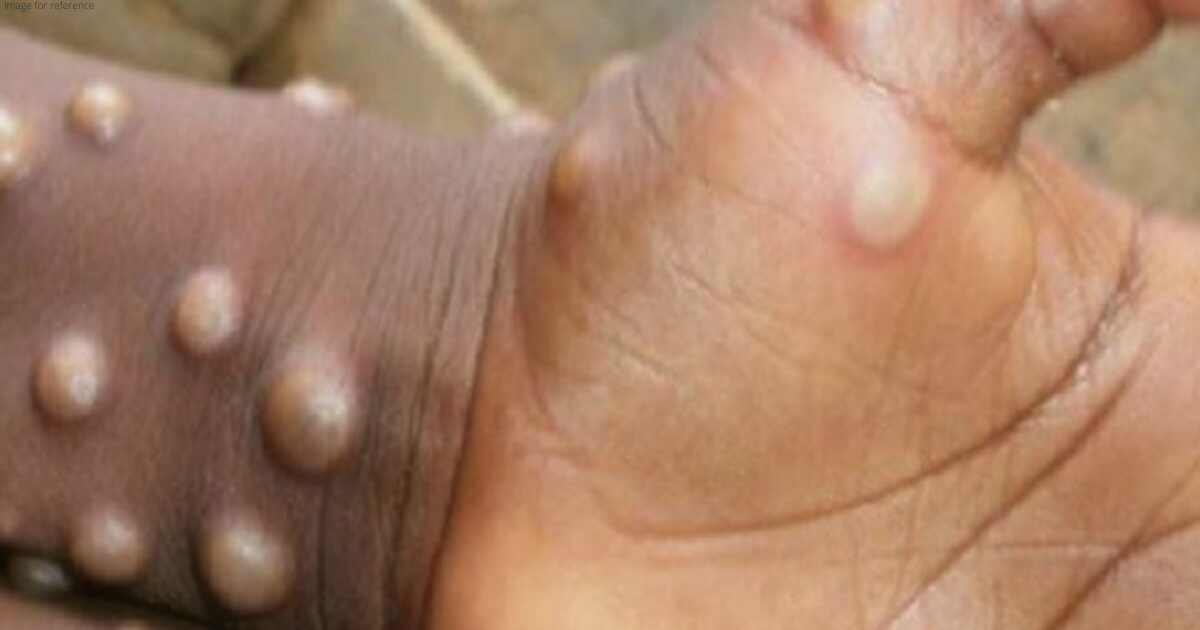 Kerala Health Minister confirms India's first monkeypox death